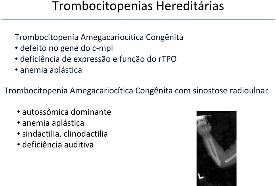 aplástica Trombocitopenia Amegacariocítica Congênita com sinostose radioulnar