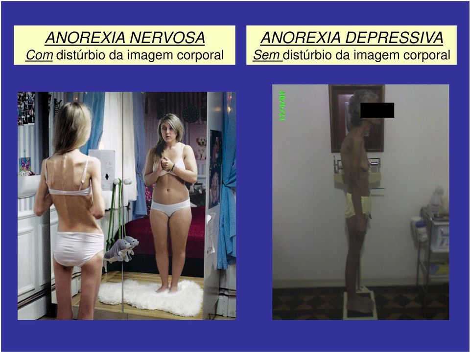 corporal ANOREXIA