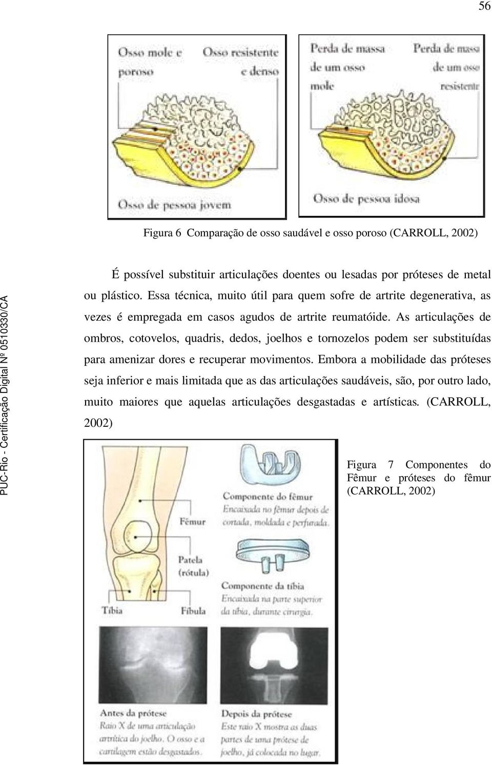 As articulações de ombros, cotovelos, quadris, dedos, joelhos e tornozelos podem ser substituídas para amenizar dores e recuperar movimentos.