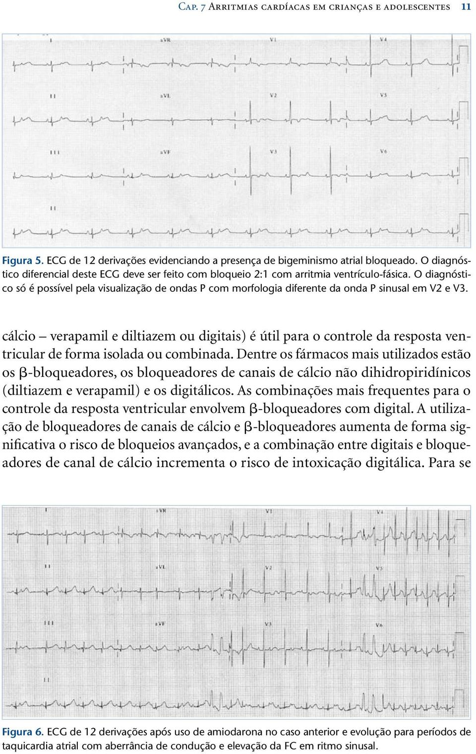 O diagnóstico só é possível pela visualização de ondas P com morfologia diferente da onda P sinusal em V2 e V3.