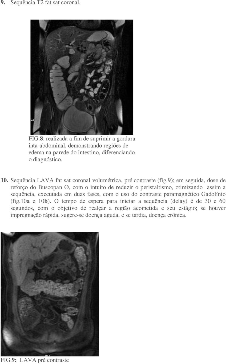 Sequência LAVA fat sat coronal volumétrica, pré contraste (fig.