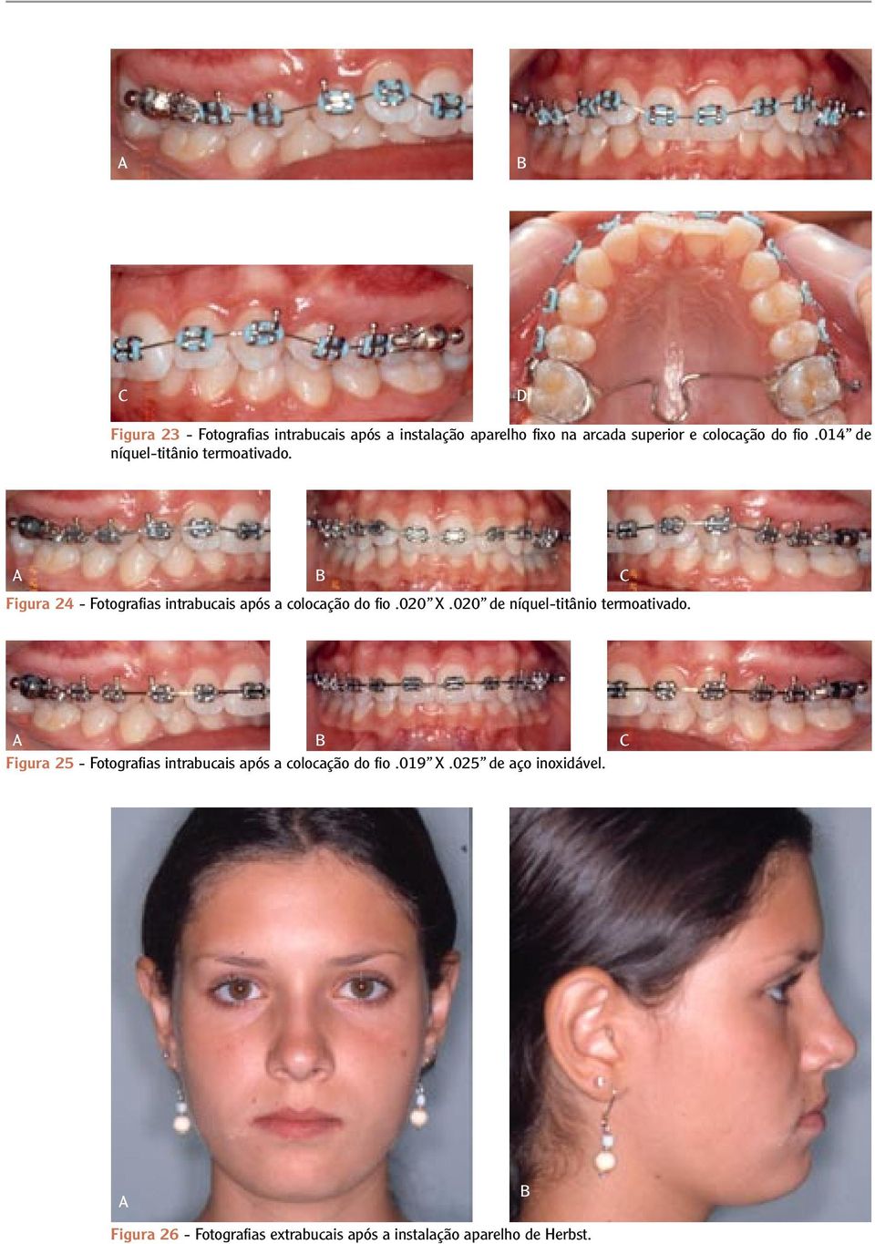 C Figura 24 - Fotografias intrabucais após a colocação do fio.020 X.020 de níquel-titânio termoativado.