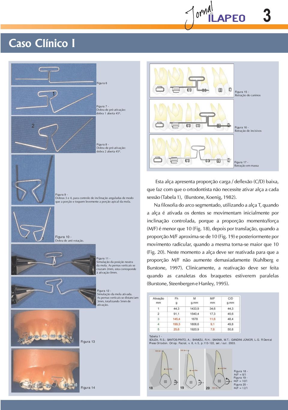 Figura 17 - Retração em massa Figura 9 - Dobras 3 e 4, para controle de inclinação anguladas de modo que a porção e toquem levemente a porção apical da mola. Figura 10 - Dobra de anti-rotação.