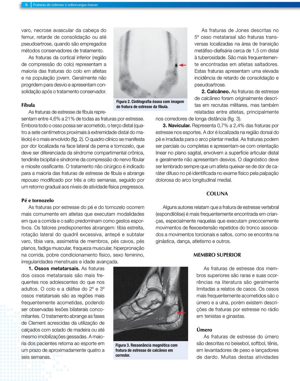 Geralmente não progridem para desvio e apresentam consolidação após o tratamento conservador. Fíbula As fraturas de estresse de fíbula representam entre 4,6% a 21% de todas as fraturas por estresse.