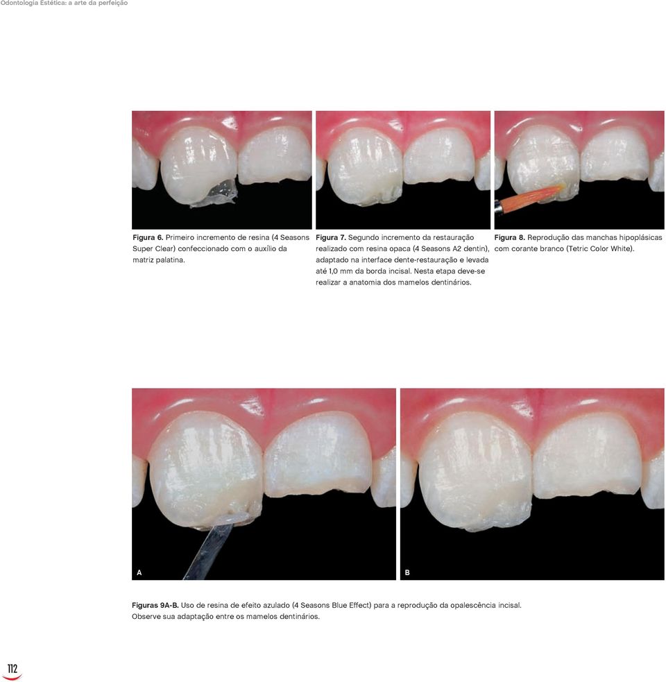 Reprodução das manchas hipoplásicas realizado com resina opaca (4 Seasons A2 dentin), com corante branco (Tetric Color White).