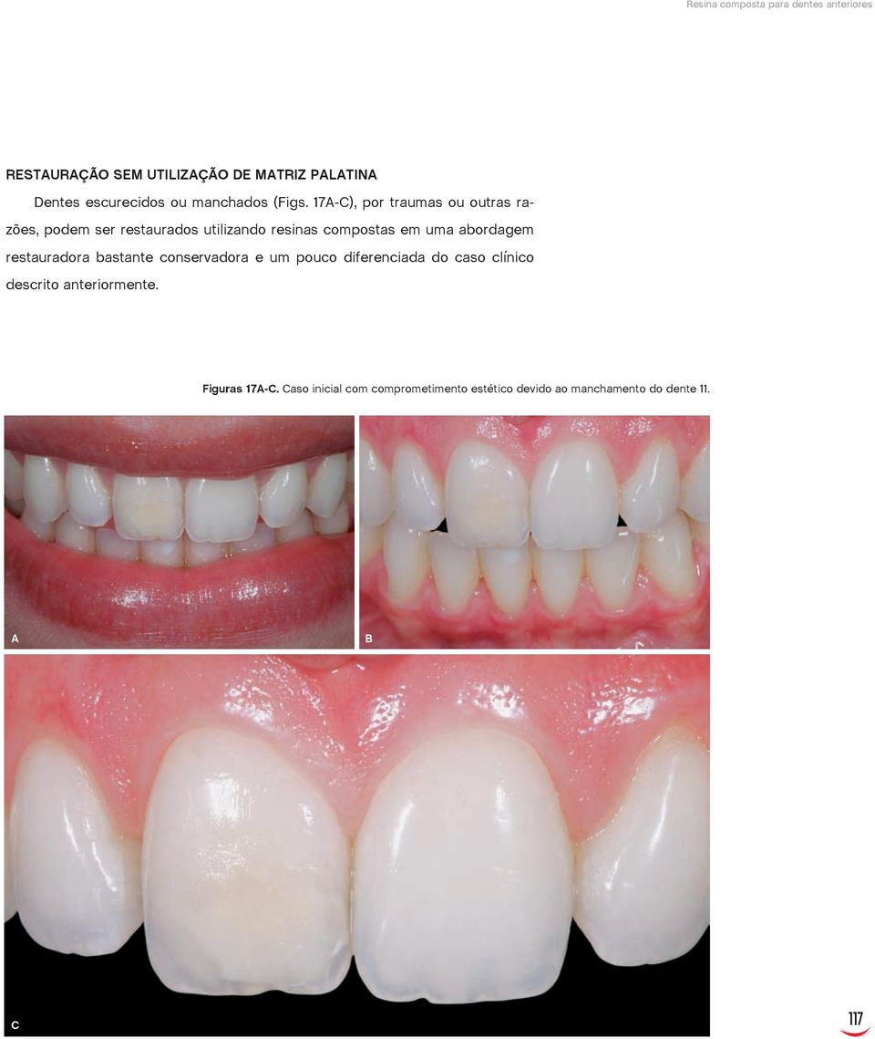 17A-C), por traumas ou outras razões, podem ser restaurados utilizando resinas compostas em uma abordagem