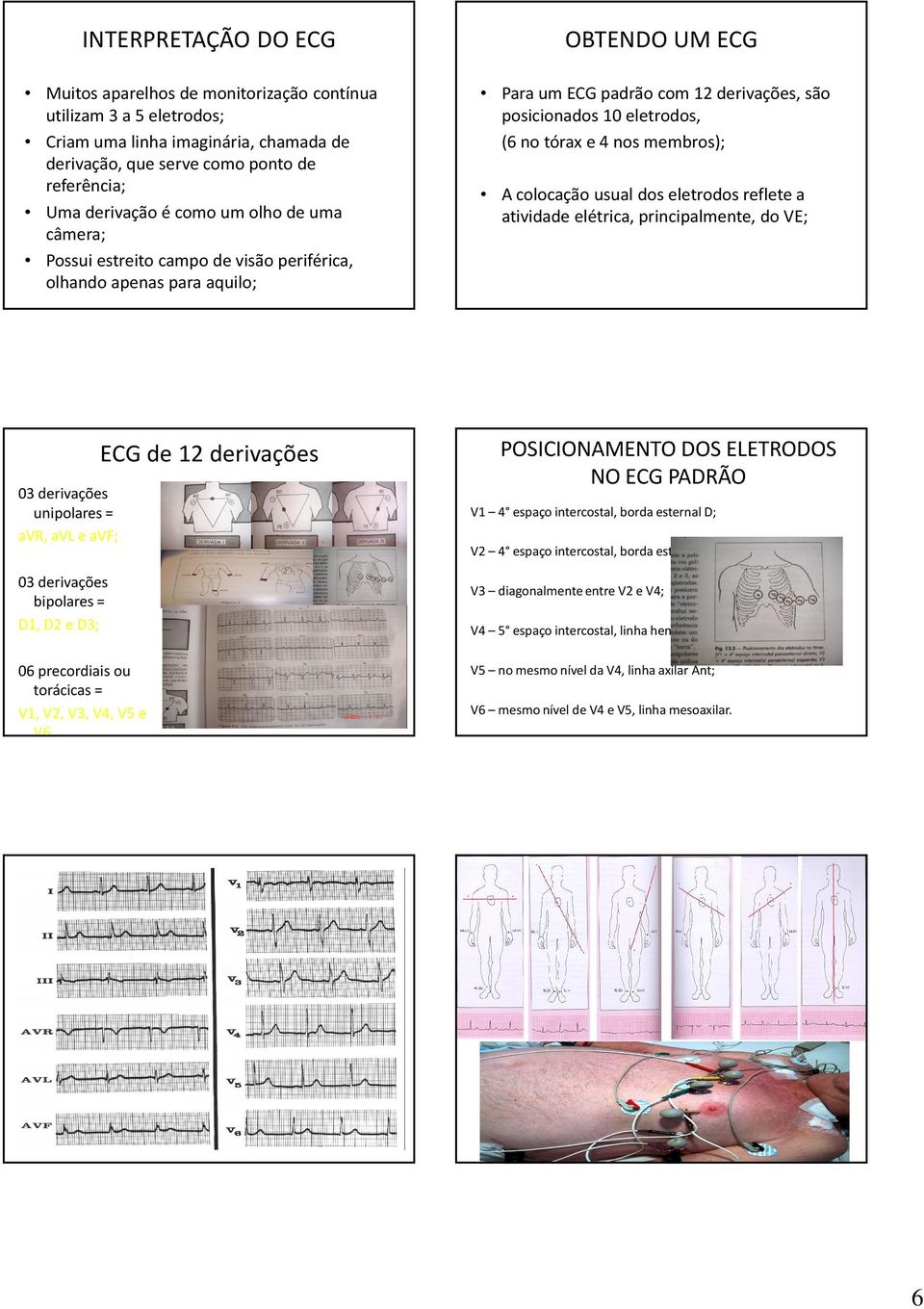 membros); A colocação usual dos eletrodos reflete a atividade elétrica, principalmente, do VE; 03 derivações unipolares = avr, avl e avf; 03 derivações bipolares = D1, D2 e D3; 06 precordiais ou