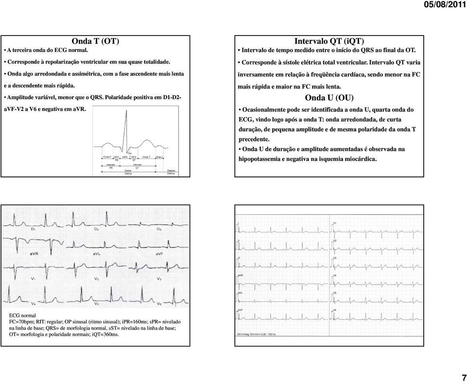 Intervalo QT (iqt) Intervalo de tempo medido entre o início do QRS ao final da OT. Corresponde à sístole elétrica total ventricular.