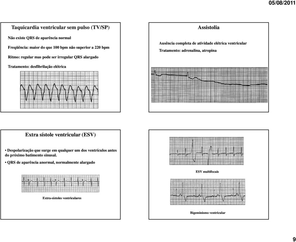 atropina Tratamento: desfibrilação elétrica Extra sístole ventricular (ESV) Despolarização que surge em qualquer um dos ventrículos antes