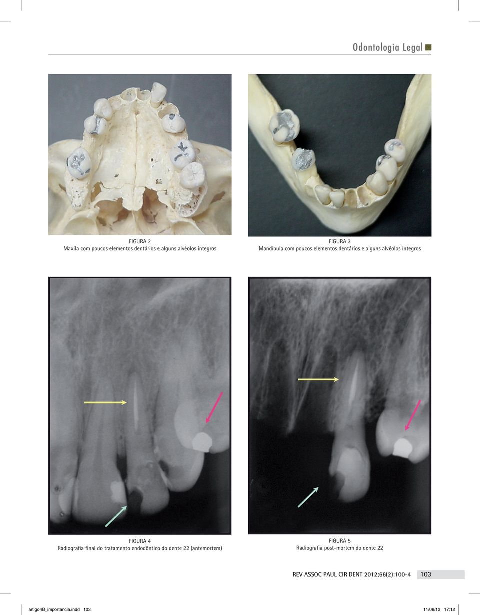 Radiografia final do tratamento endodôntico do dente 22 (antemortem) Figura 5 Radiografia