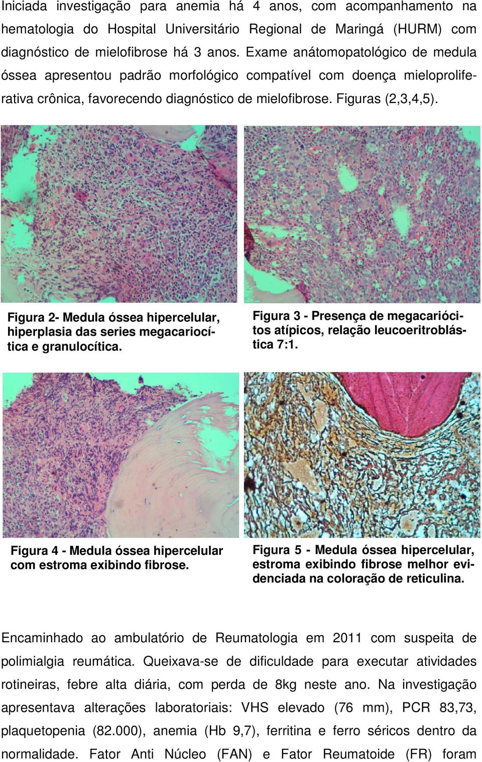 Figura 2- Medula óssea hipercelular, hiperplasia das series megacariocítica e granulocítica. Figura 3 - Presença de megacariócitos atípicos, relação leucoeritroblástica 7:1.