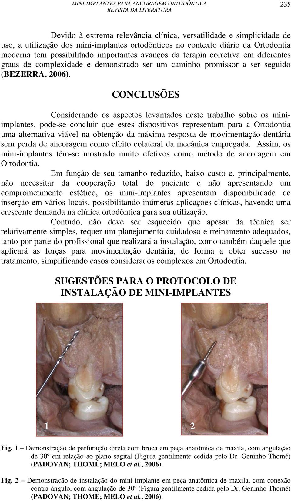 CONCLUSÕES Considerando os aspectos levantados neste trabalho sobre os miniimplantes, pode-se concluir que estes dispositivos representam para a Ortodontia uma alternativa viável na obtenção da