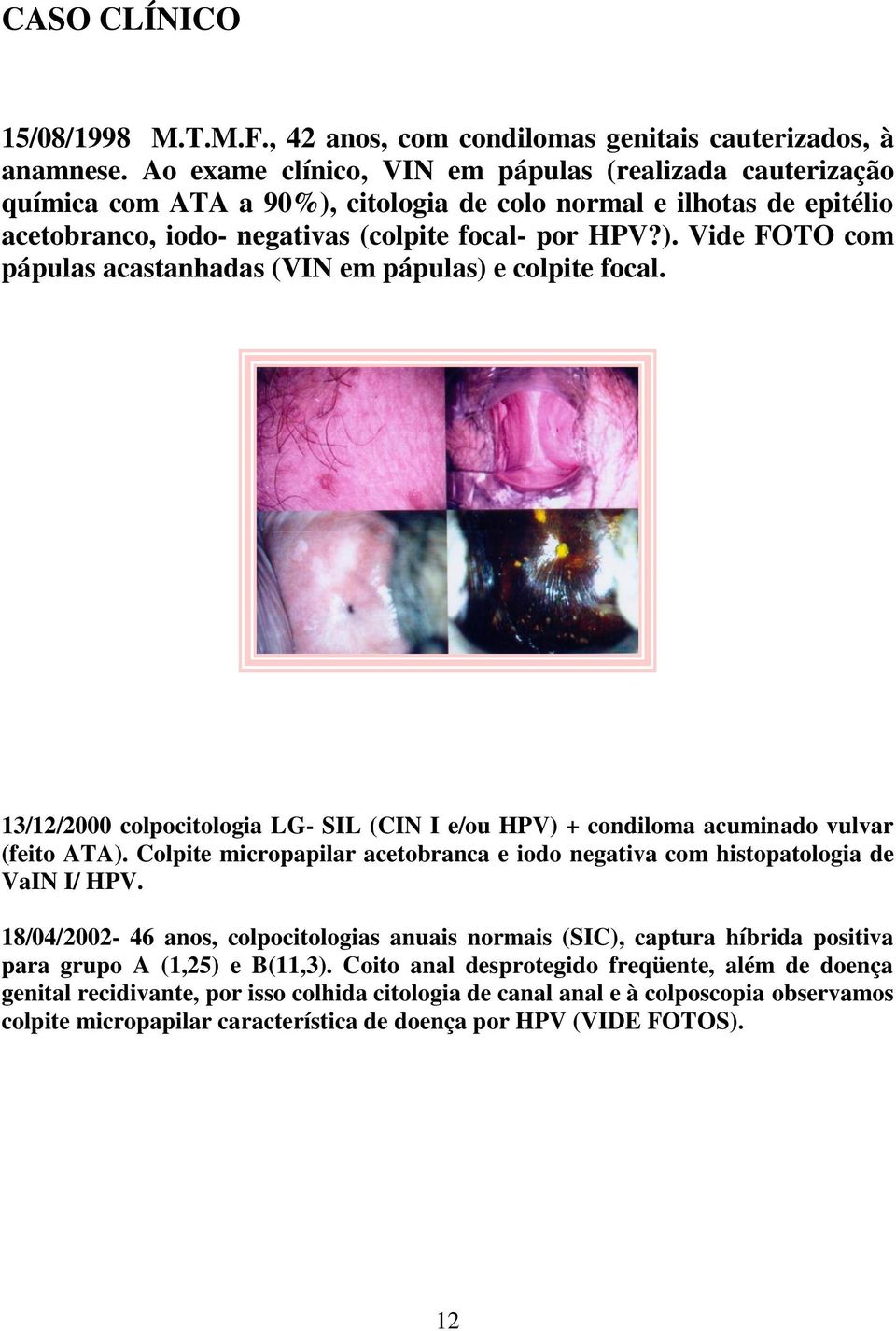 13/12/2000 colpocitologia LG- SIL (CIN I e/ou HPV) + condiloma acuminado vulvar (feito ATA). Colpite micropapilar acetobranca e iodo negativa com histopatologia de VaIN I/ HPV.