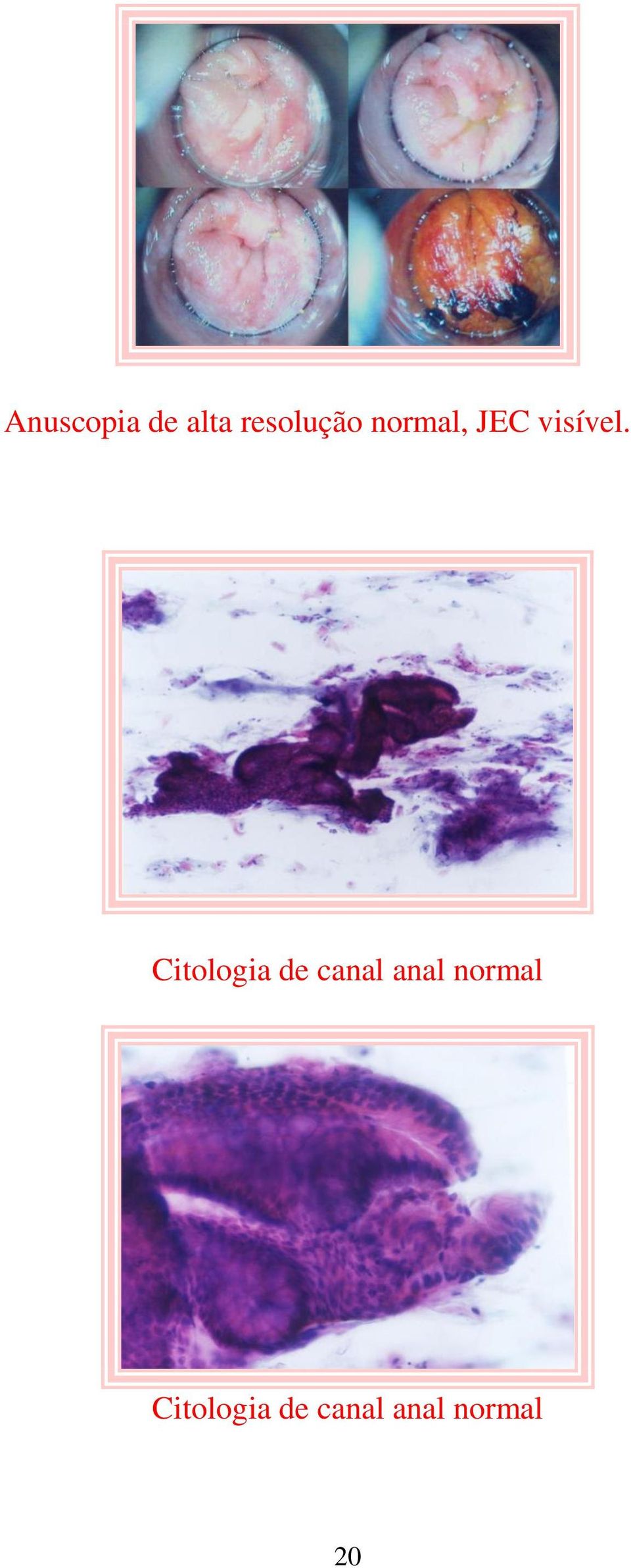 Citologia de canal anal