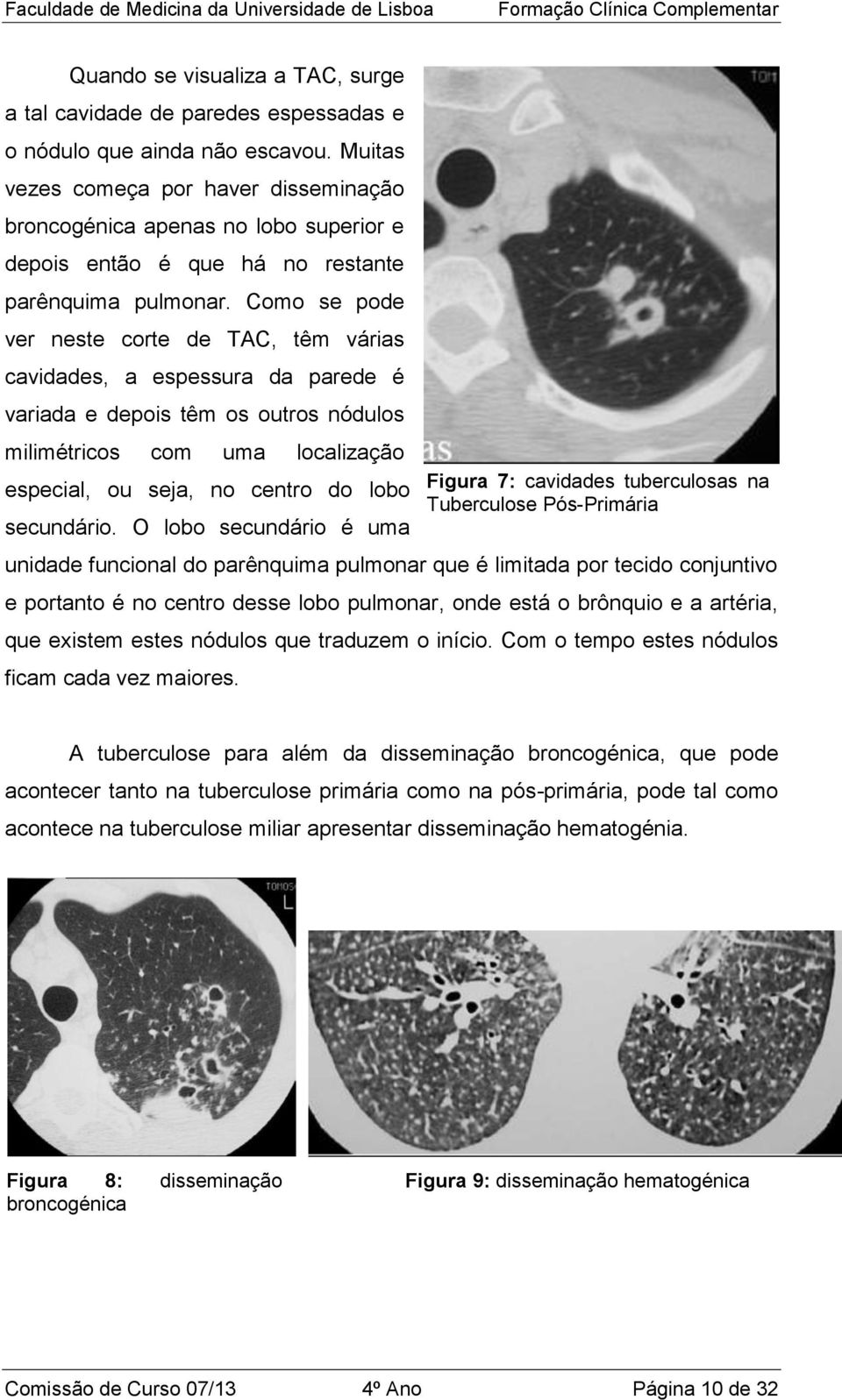 Como se pode ver neste corte de TAC, têm várias cavidades, a espessura da parede é variada e depois têm os outros nódulos milimétricos com uma localização especial, ou seja, no centro do lobo