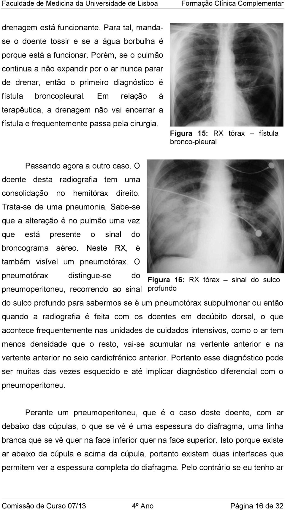 Em relação à terapêutica, a drenagem não vai encerrar a fístula e frequentemente passa pela cirurgia. Figura 15: RX tórax fístula bronco-pleural Passando agora a outro caso.