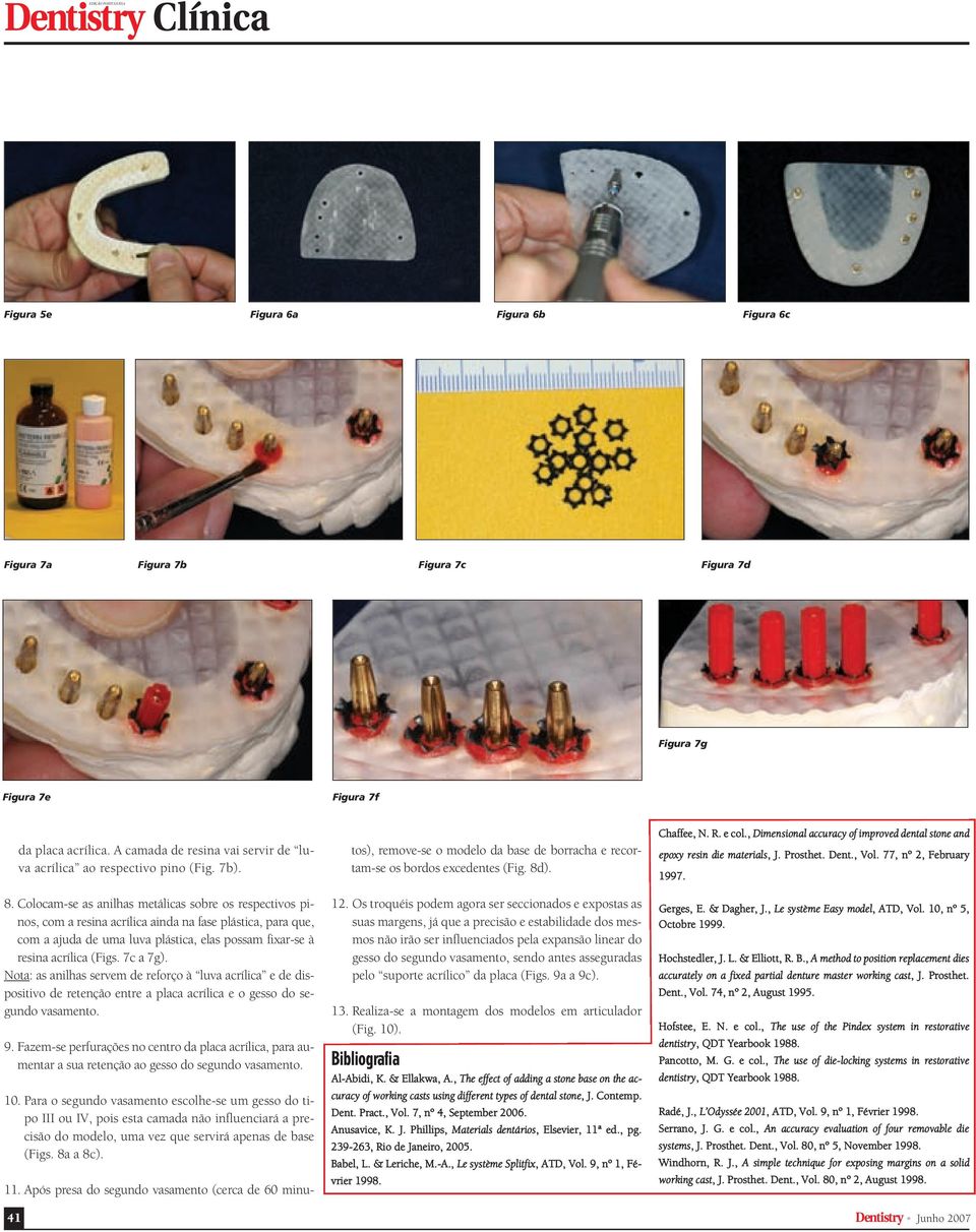 Colocam-se as anilhas metálicas sobre os respectivos pinos, com a resina acrílica ainda na fase plástica, para que, com a ajuda de uma luva plástica, elas possam fixar-se à resina acrílica (Figs.