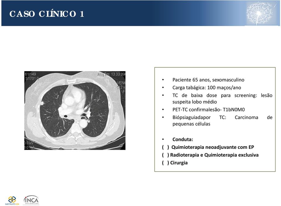 T1bN0M0 Biópsiaguiadapor TC: Carcinoma de pequenas células Conduta: ( )
