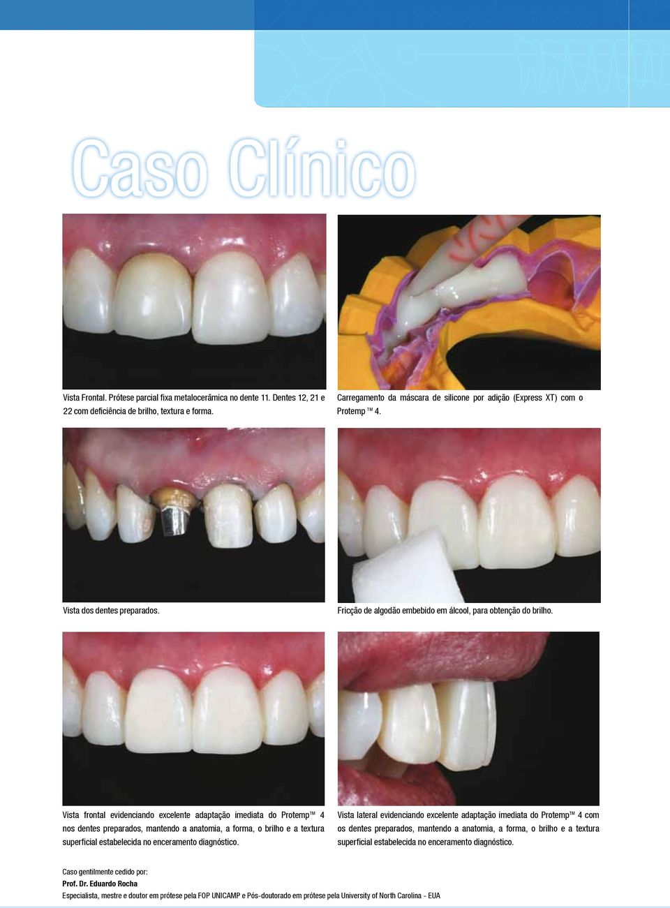 Vista frontal evidenciando excelente adaptação imediata do Protemp TM 4 nos dentes preparados, mantendo a anatomia, a forma, o brilho e a textura superficial estabelecida no enceramento diagnóstico.