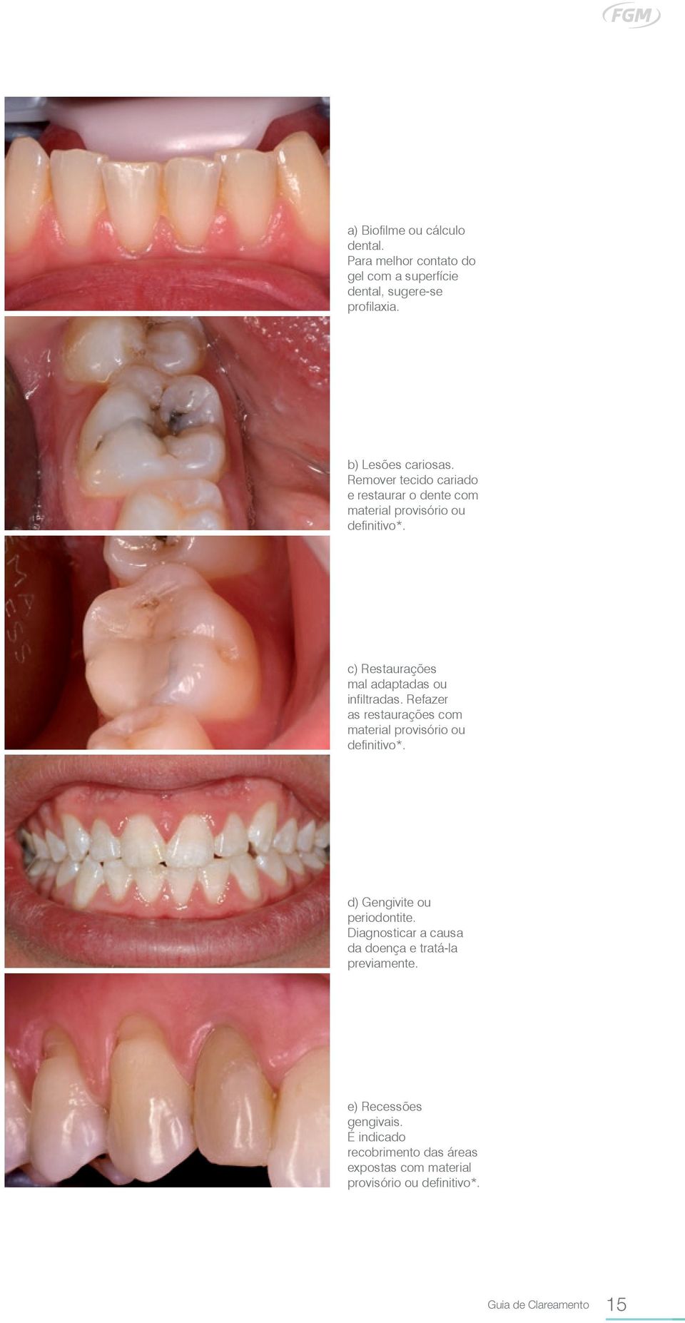 Refazer as restaurações com material provisório ou definitivo*. d) Gengivite ou periodontite.
