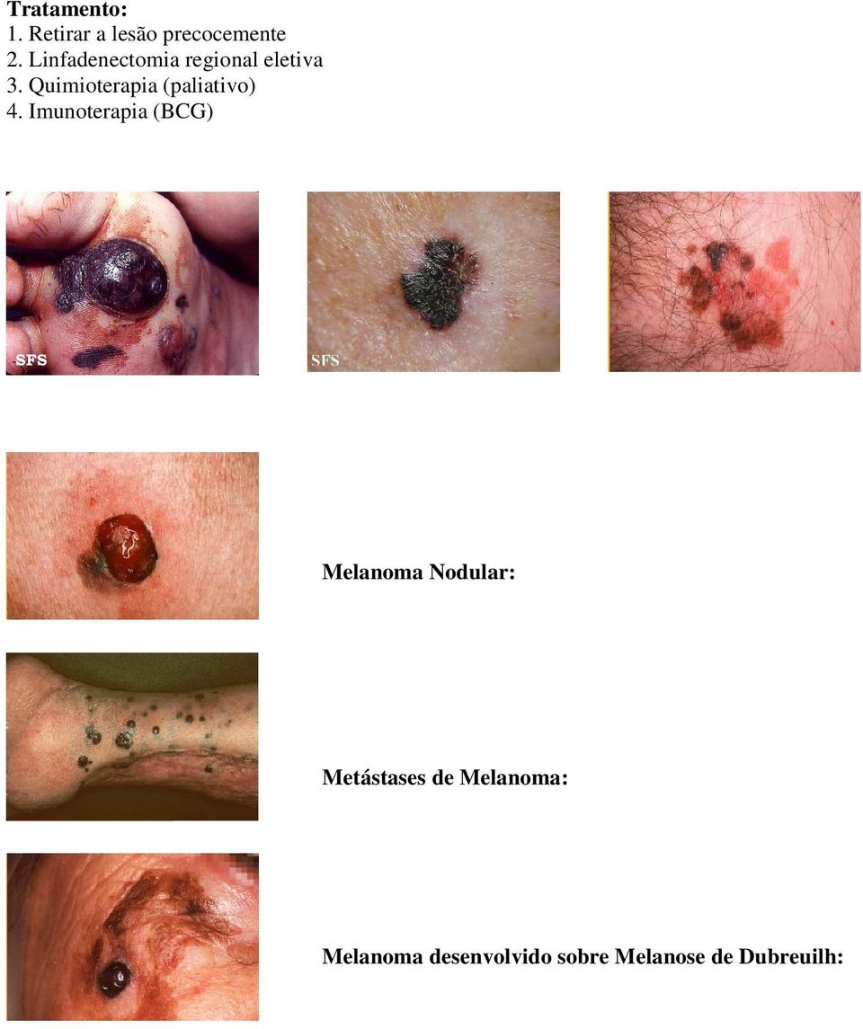 Quimioterapia (paliativo) 4.