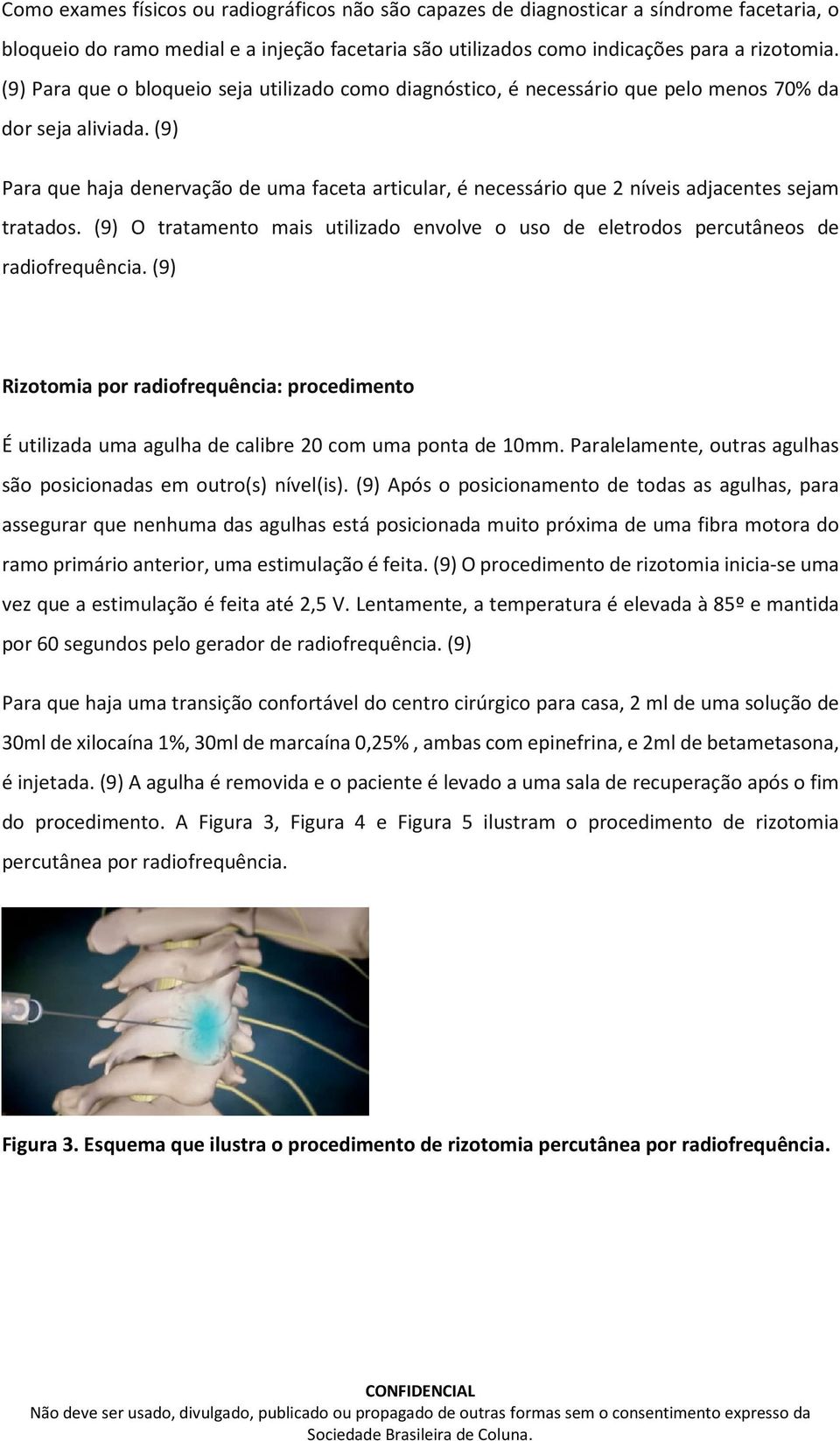 (9) Para que haja denervação de uma faceta articular, é necessário que 2 níveis adjacentes sejam tratados. (9) O tratamento mais utilizado envolve o uso de eletrodos percutâneos de radiofrequência.