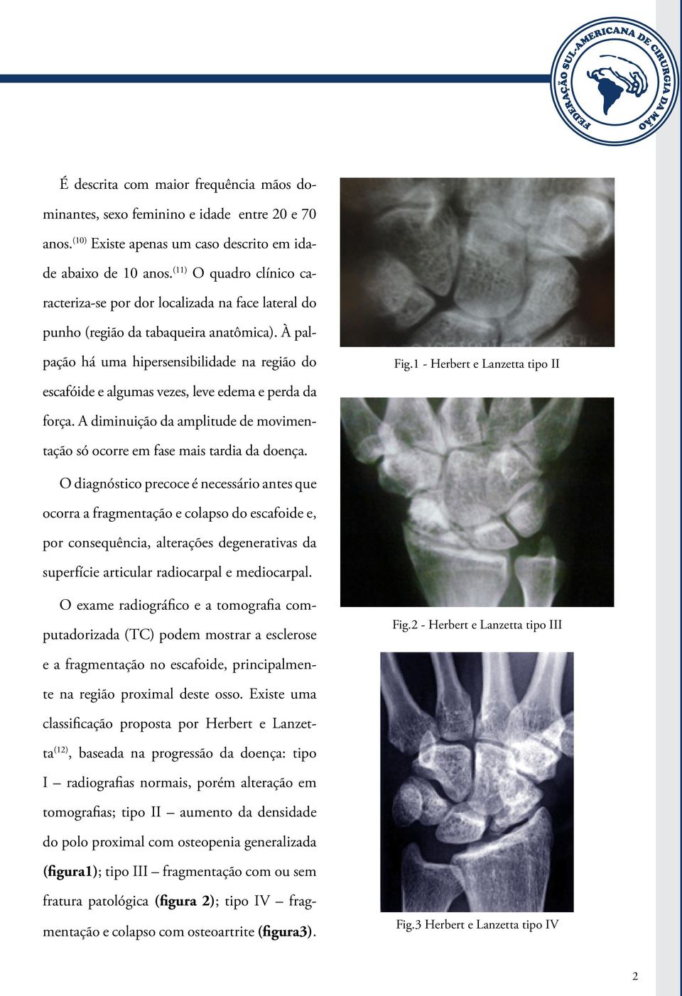 1 - Herbert e Lanzetta tipo II escafóide e algumas vezes, leve edema e perda da força. A diminuição da amplitude de movimentação só ocorre em fase mais tardia da doença.