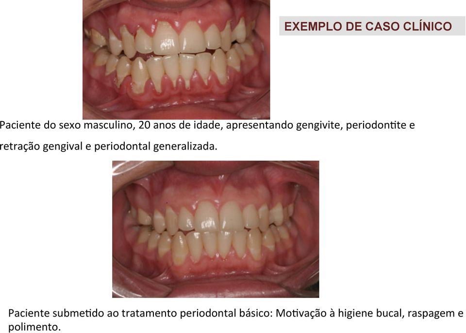 e periodontal generalizada.