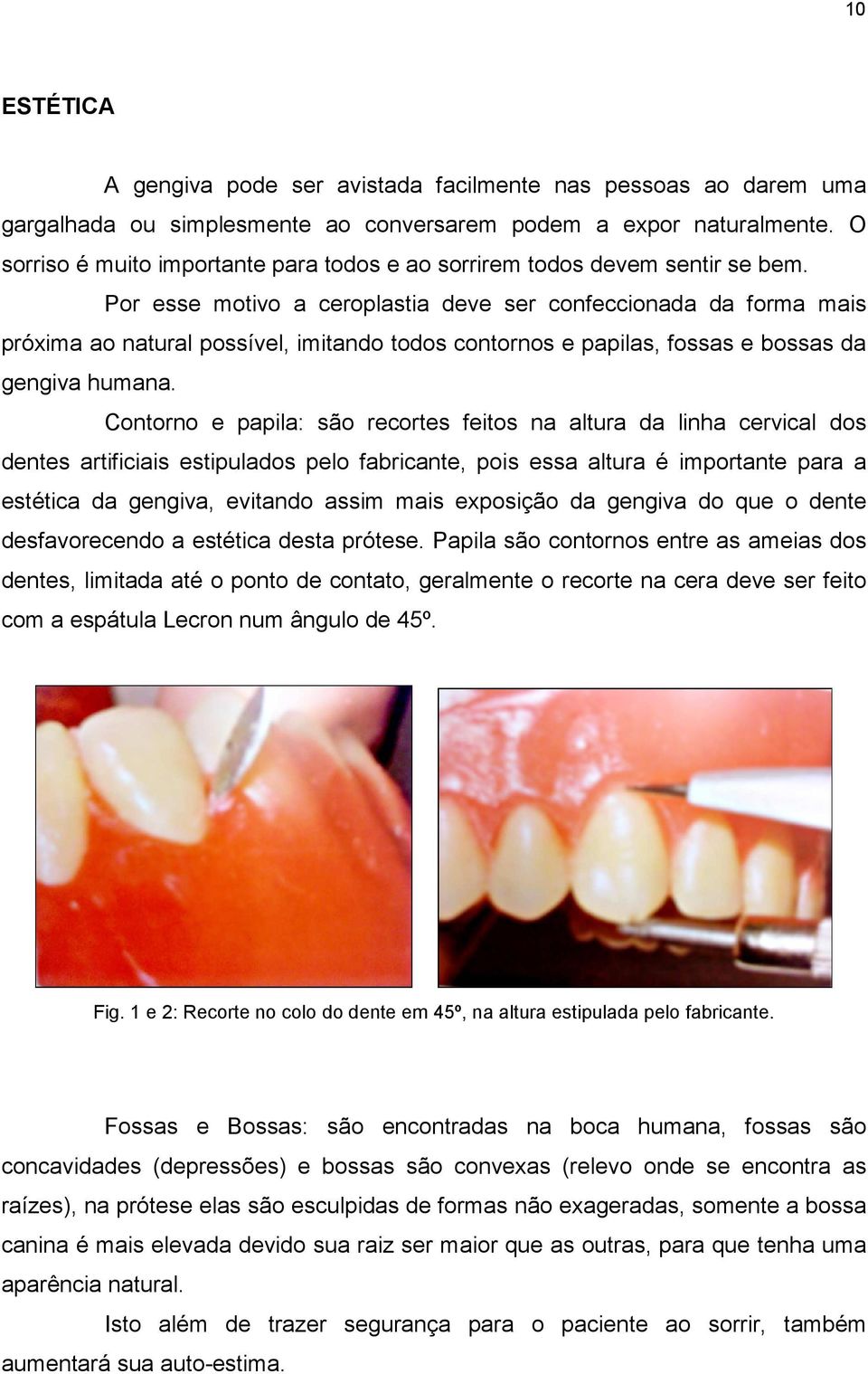 Por esse motivo a ceroplastia deve ser confeccionada da forma mais próxima ao natural possível, imitando todos contornos e papilas, fossas e bossas da gengiva humana.