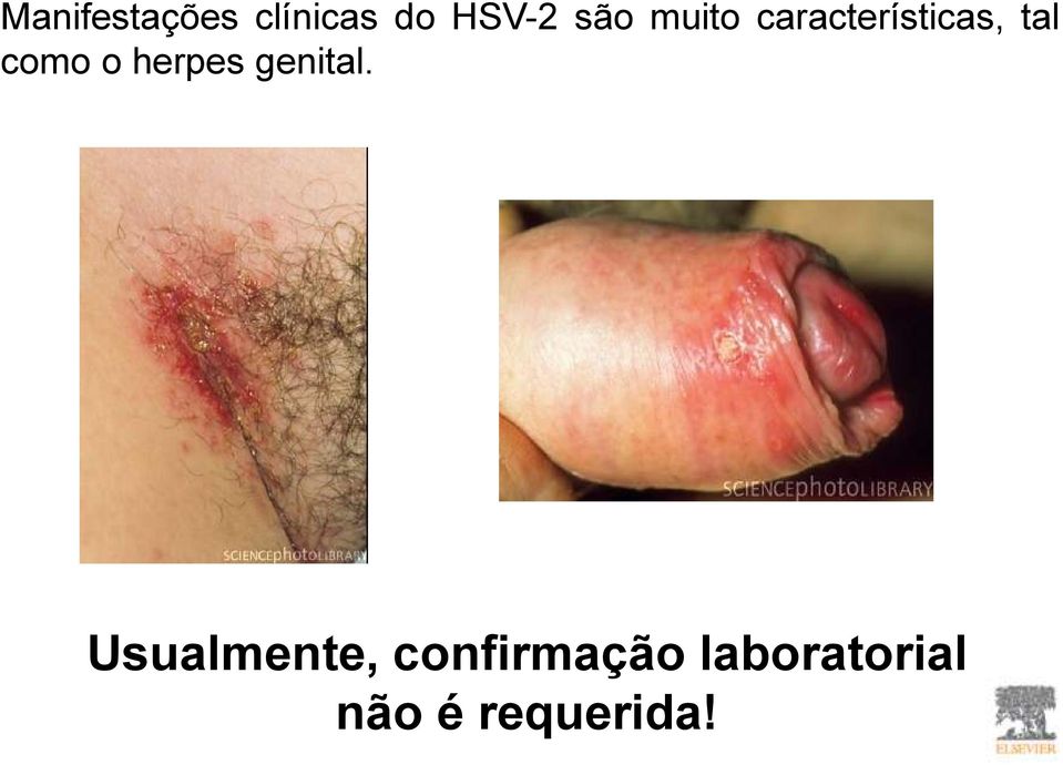 como o herpes genital.