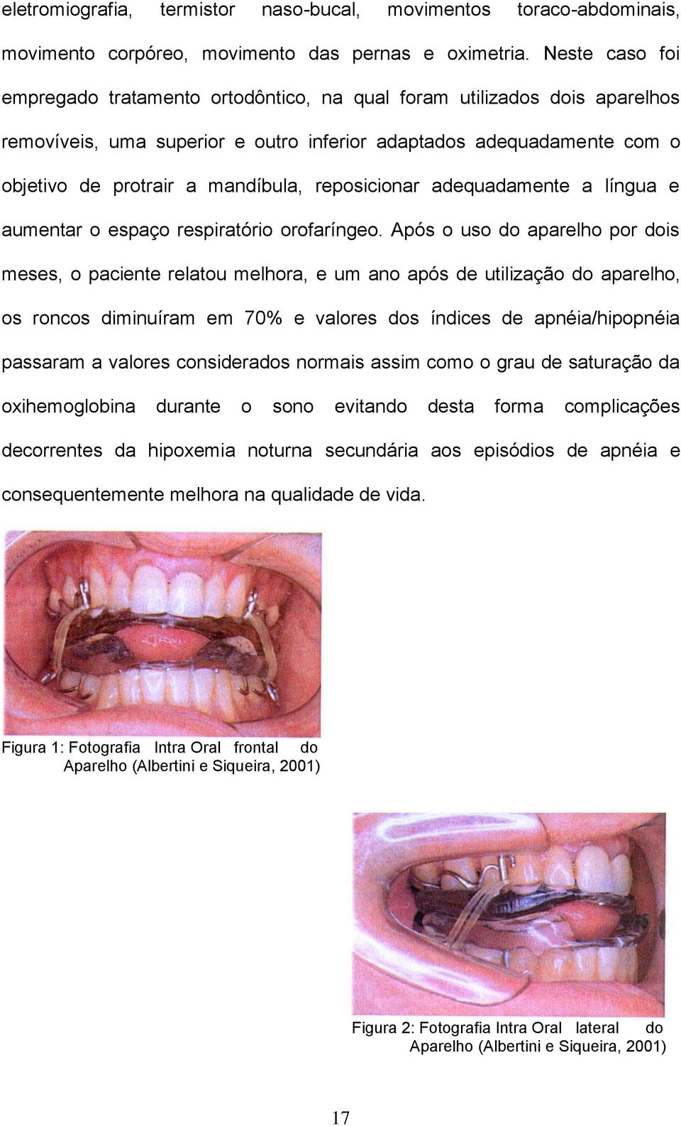 reposicionar adequadamente a língua e aumentar o espaço respiratório orofaríngeo.