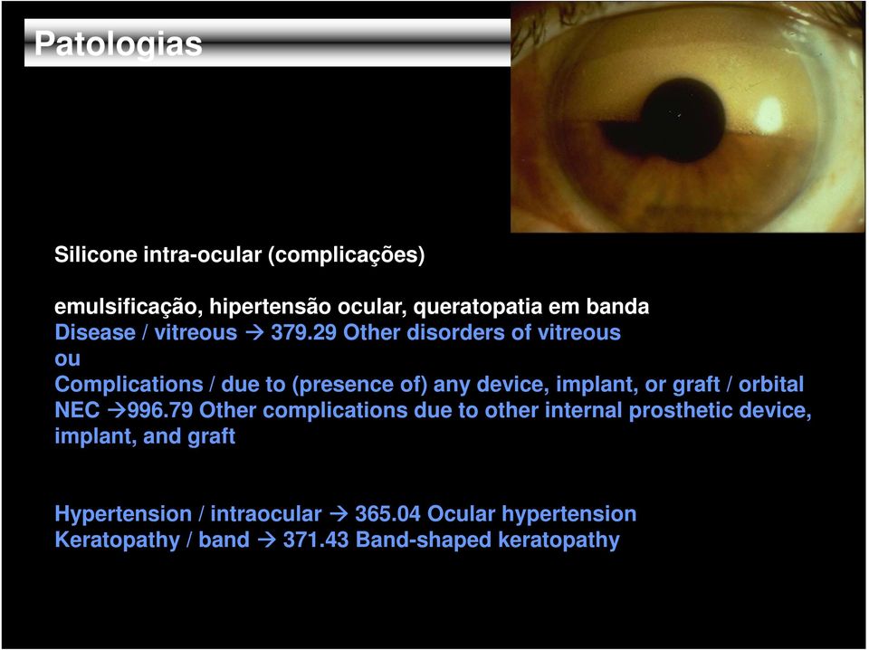 29 Other disorders of vitreous ou Complications / due to (presence of) any device, implant, or graft /