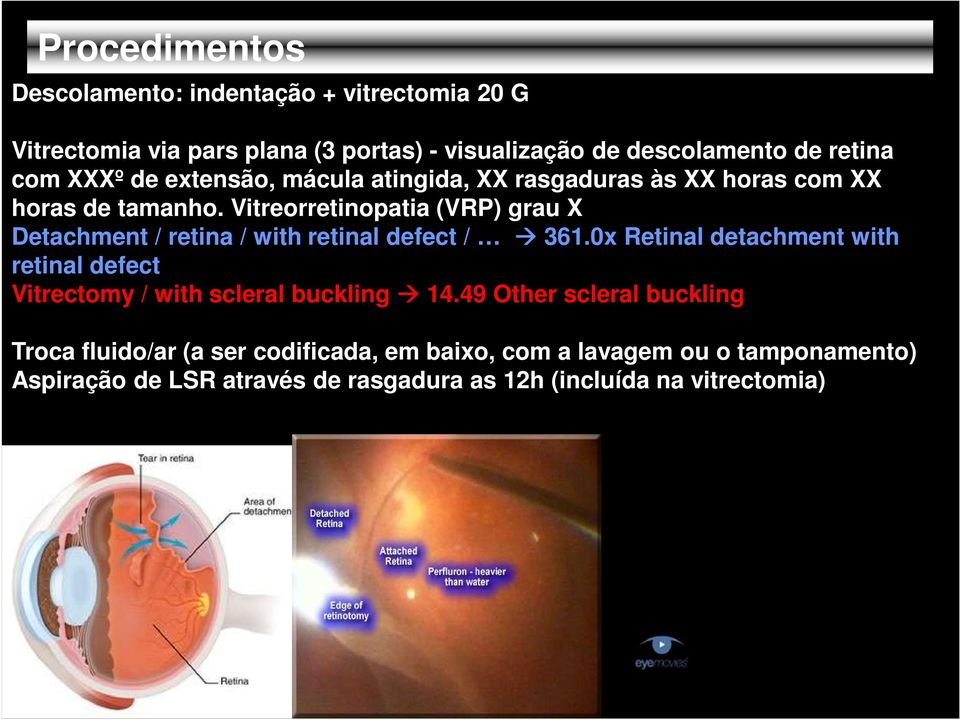 Vitreorretinopatia (VRP) grau X Detachment / retina / with retinal defect / 361.