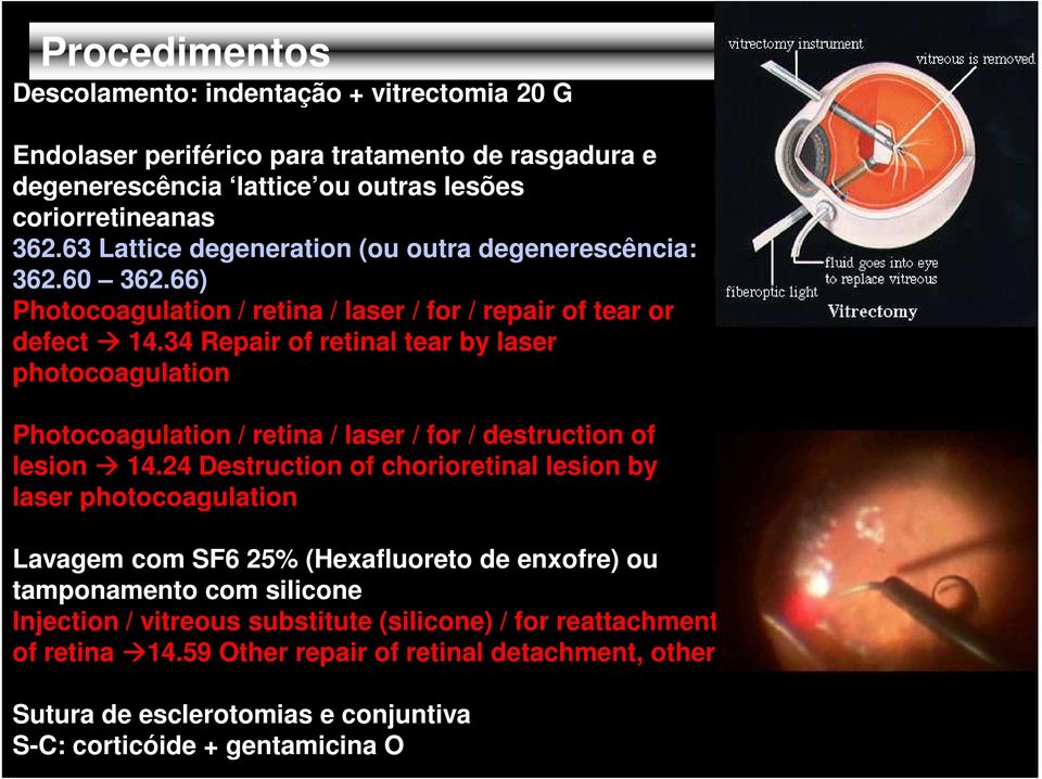34 Repair of retinal tear by laser photocoagulation Photocoagulation / retina / laser / for / destruction of lesion 14.