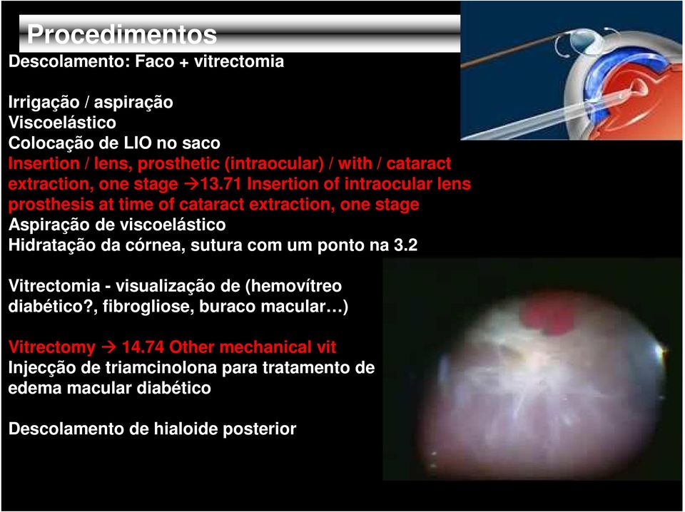 71 Insertion of intraocular lens prosthesis at time of cataract extraction, one stage Aspiração de viscoelástico Hidratação da córnea, sutura com