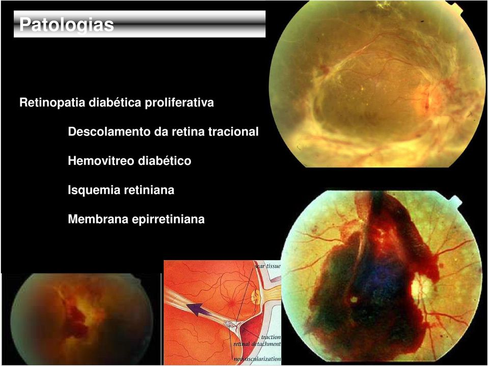 retina tracional Hemovitreo