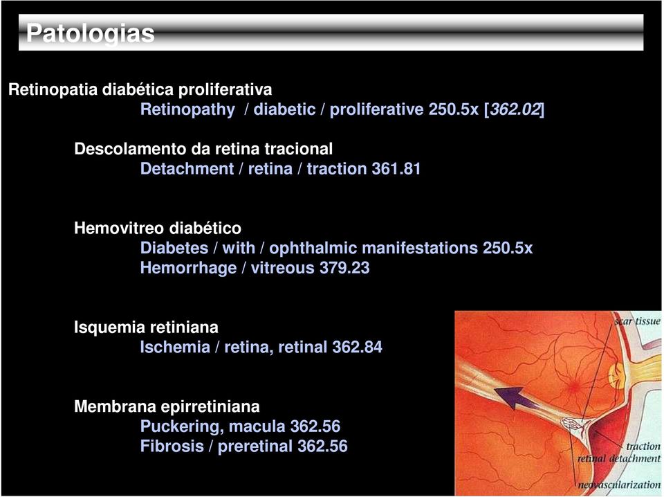 81 Hemovitreo diabético Diabetes / with / ophthalmic manifestations 250.5x Hemorrhage / vitreous 379.