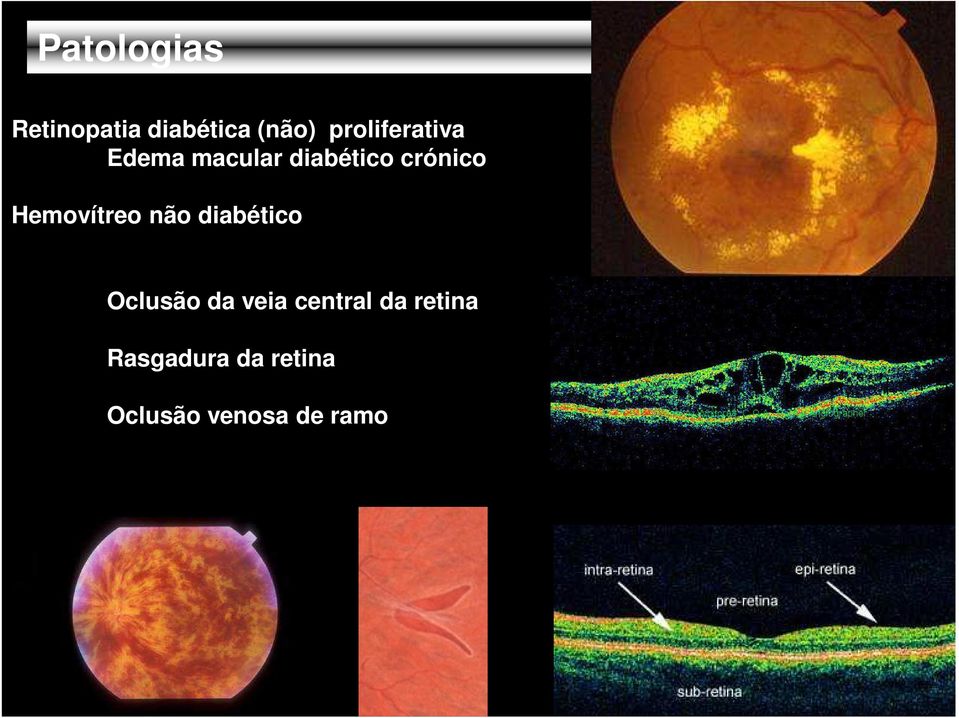 Hemovítreo não diabético Oclusão da veia