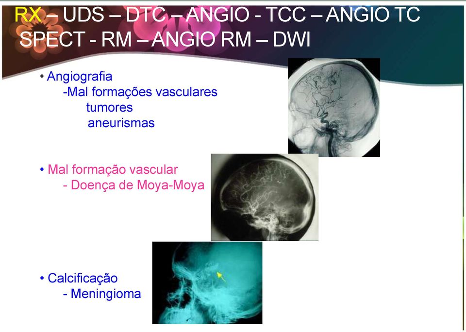 tumores aneurismas Mal formação