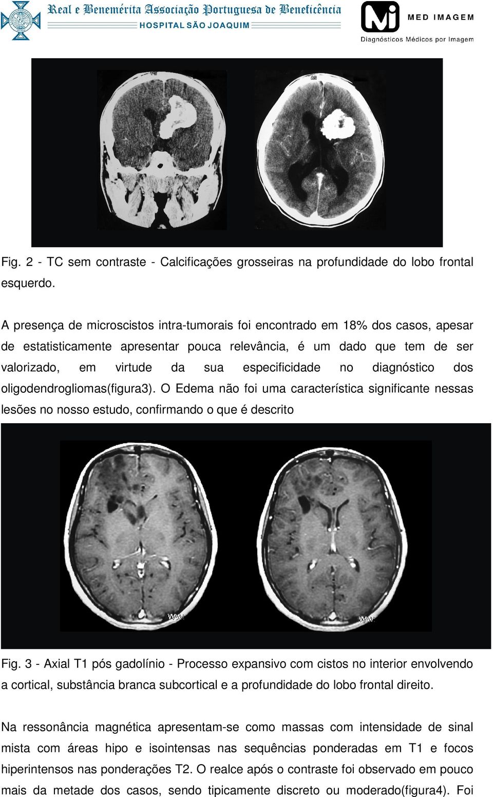 especificidade no diagnóstico dos oligodendrogliomas(figura3). O Edema não foi uma característica significante nessas lesões no nosso estudo, confirmando o que é descrito Fig.