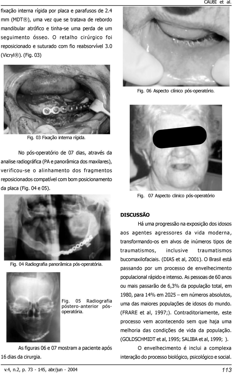 No pós-operatório de 07 dias, através da analise radiográfica (PA e panorâmica dos maxilares), verificou-se o alinhamento dos fragmentos reposicionados compatível com bom posicionamento da placa (Fig.