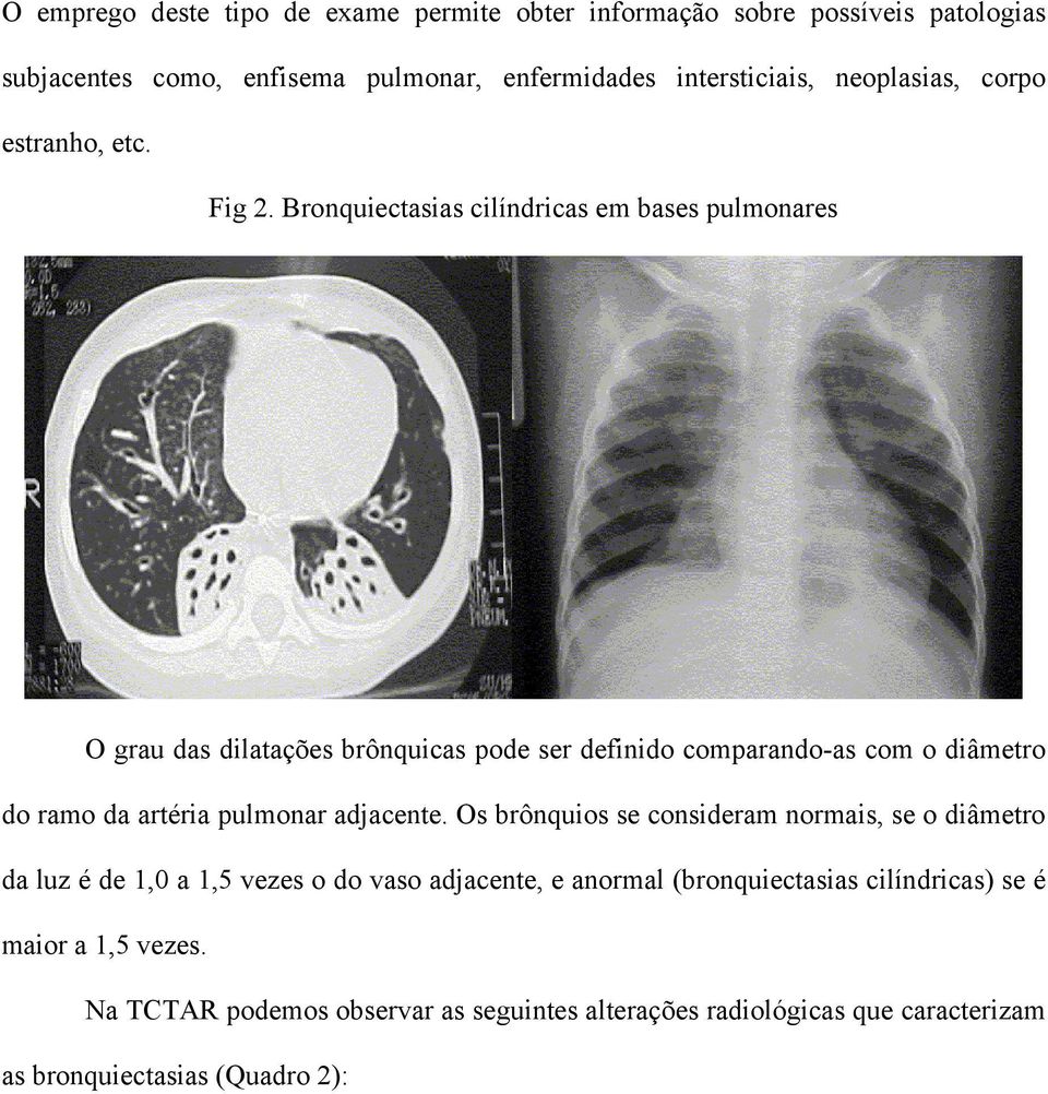 Bronquiectasias cilíndricas em bases pulmonares O grau das dilatações brônquicas pode ser definido comparando-as com o diâmetro do ramo da artéria pulmonar