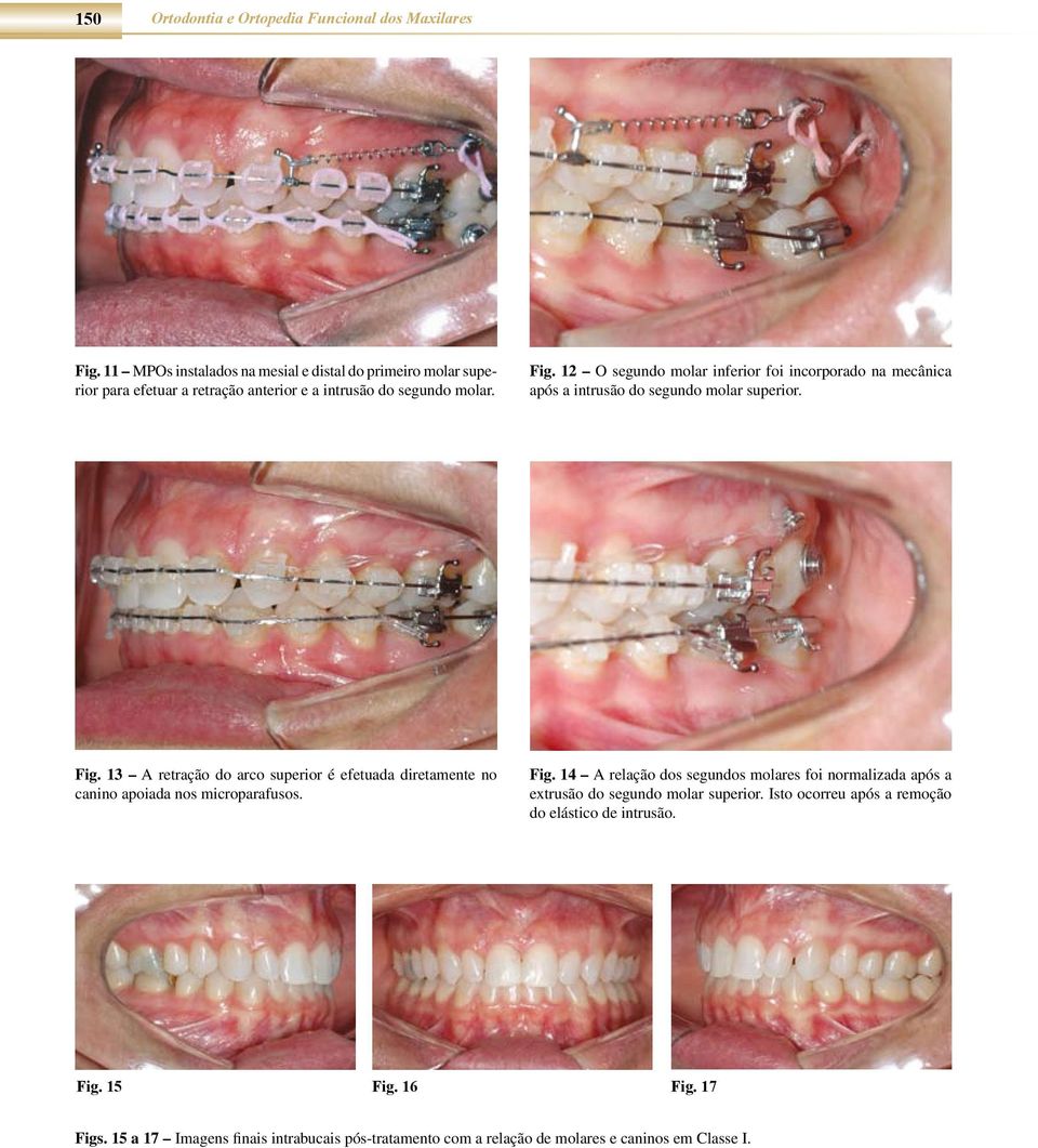 12 O segundo molar inferior foi incorporado na mecânica após a intrusão do segundo molar superior. Fig.