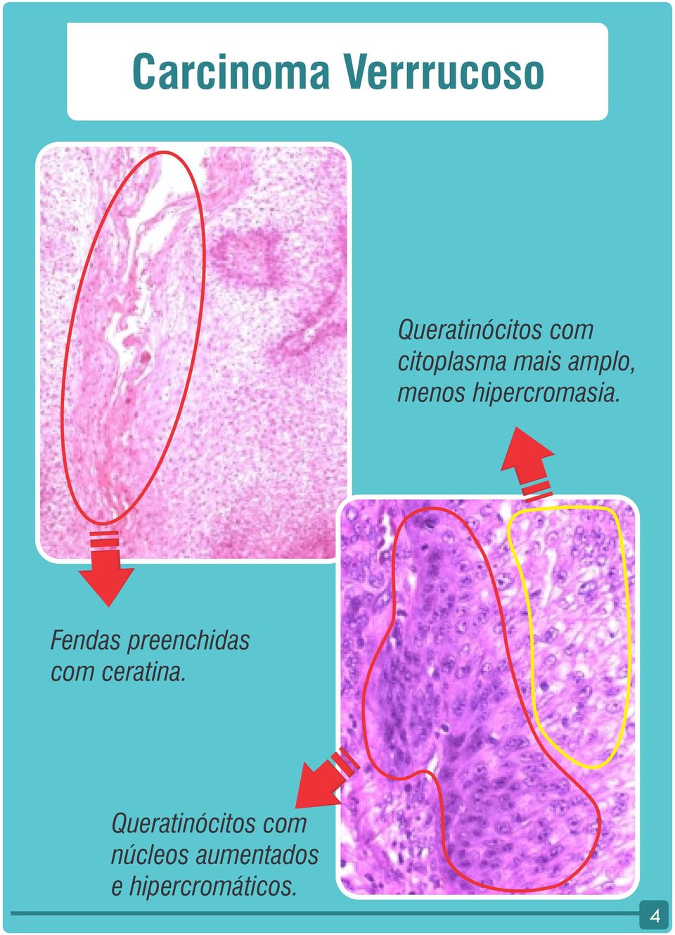 Fendas preenchidas com ceratina.