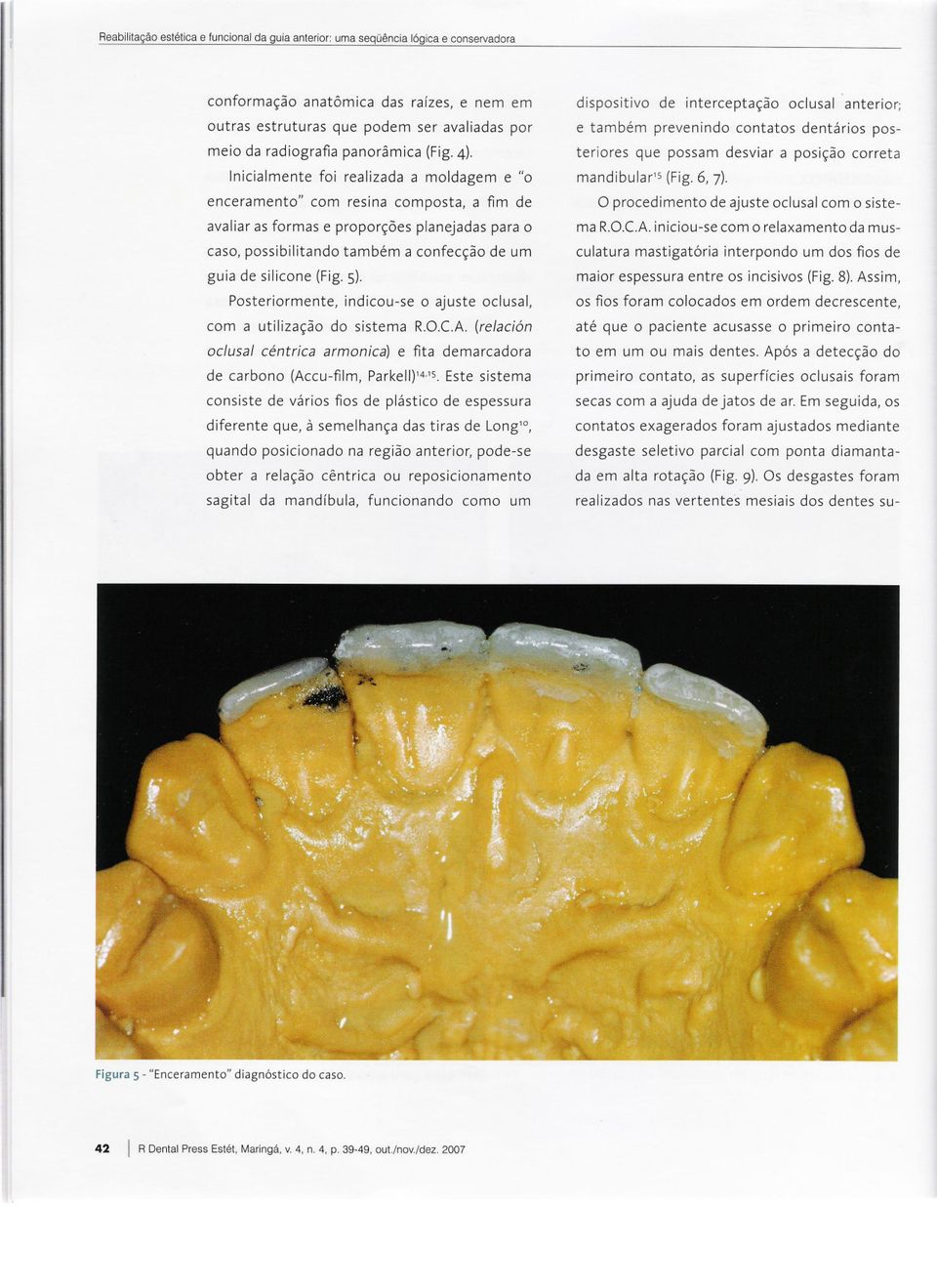 Inicialmente foi realizada a moldagem e "o enceramento" com resina composta, a fim de avaliaras formas e proporções planejadas para o caso, possibilitando também a confecção de um guia de silicone