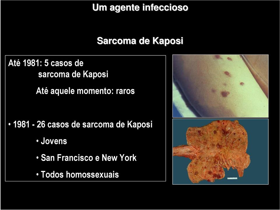 Sarcoma de Kaposi 1981-26 casos de sarcoma de