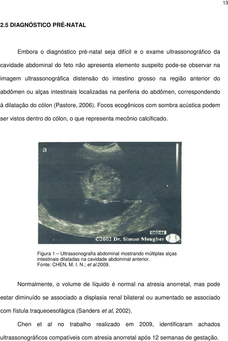 Focos ecogênicos com sombra acústica podem ser vistos dentro do cólon, o que representa mecônio calcificado.