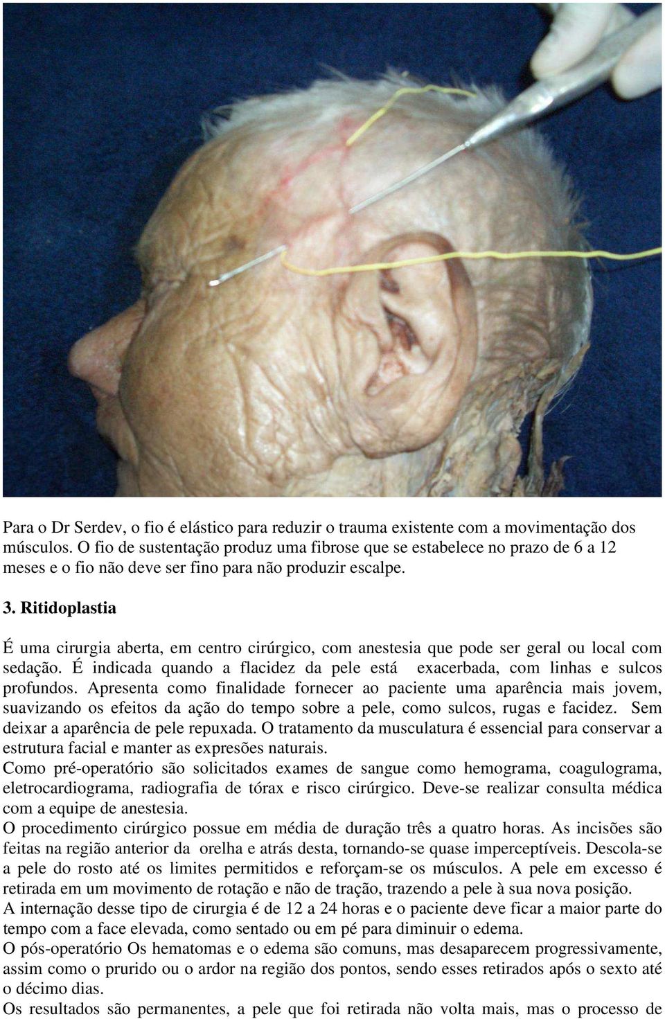 Ritidoplastia É uma cirurgia aberta, em centro cirúrgico, com anestesia que pode ser geral ou local com sedação. É indicada quando a flacidez da pele está exacerbada, com linhas e sulcos profundos.