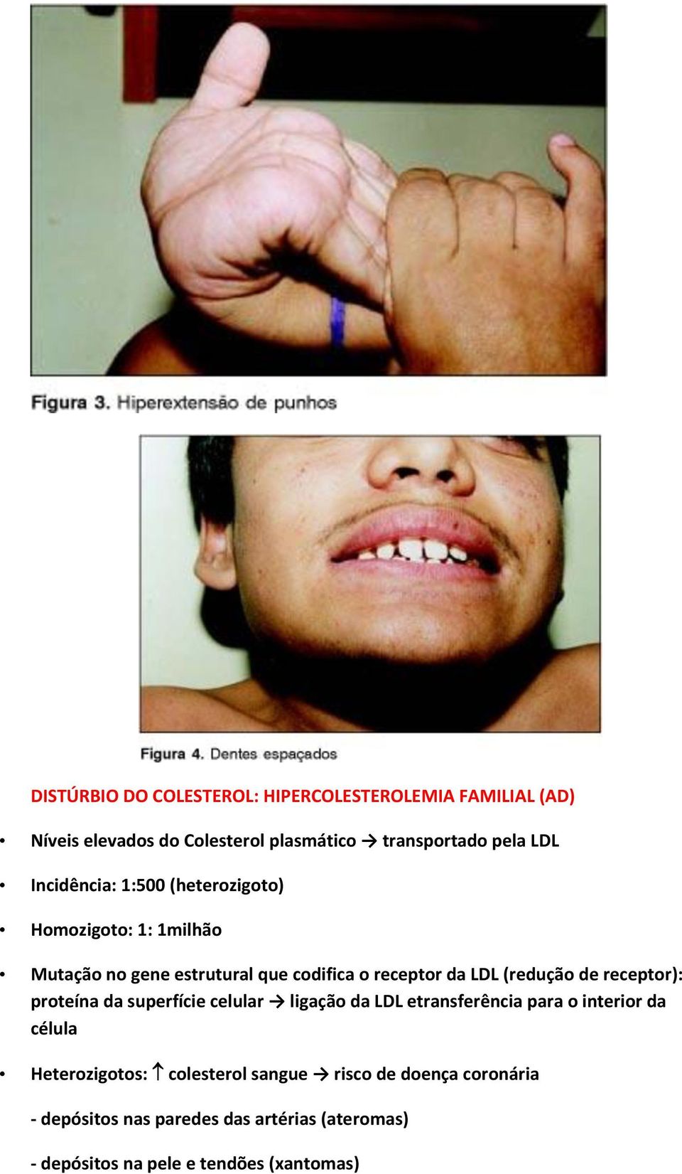 de receptor): proteína da superfície celular ligação da LDL etransferência para o interior da célula Heterozigotos: