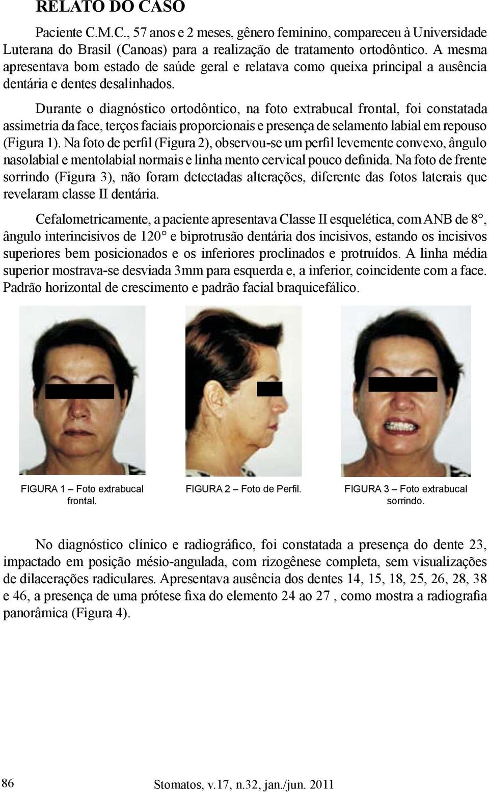 Durante o diagnóstico ortodôntico, na foto extrabucal frontal, foi constatada assimetria da face, terços faciais proporcionais e presença de selamento labial em repouso (Figura 1).
